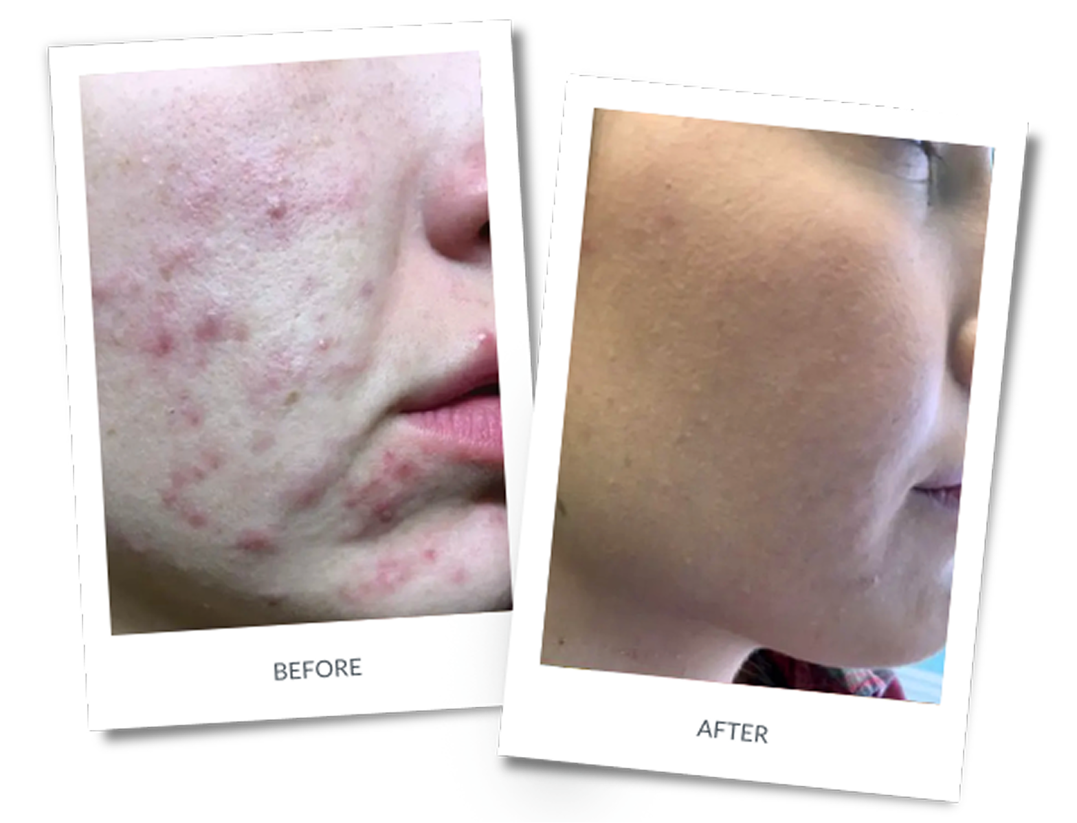 Before and after: Acne