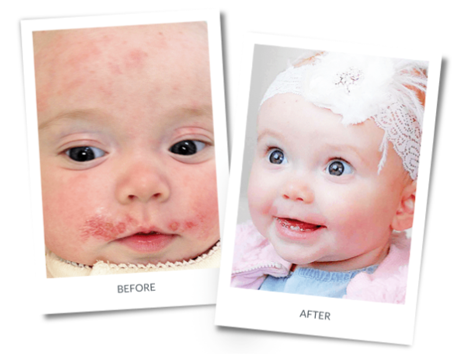 Before and after: Eczema