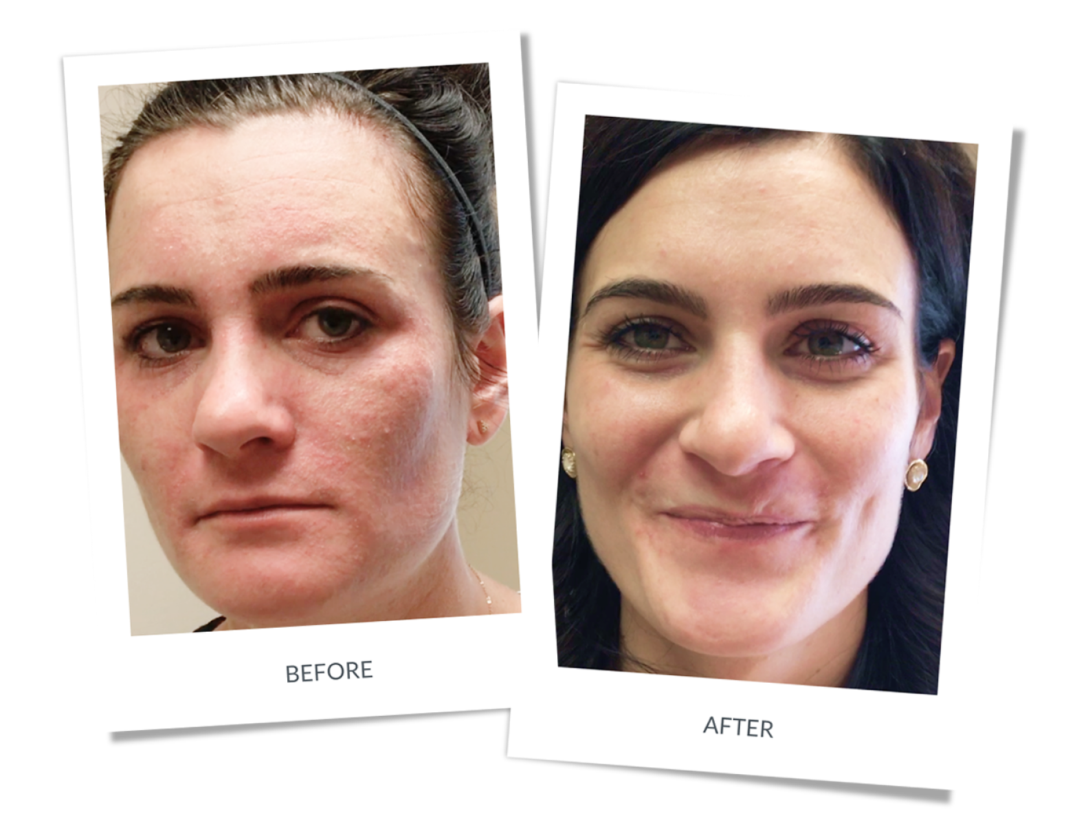 Before and after: Perioral Dermatitis