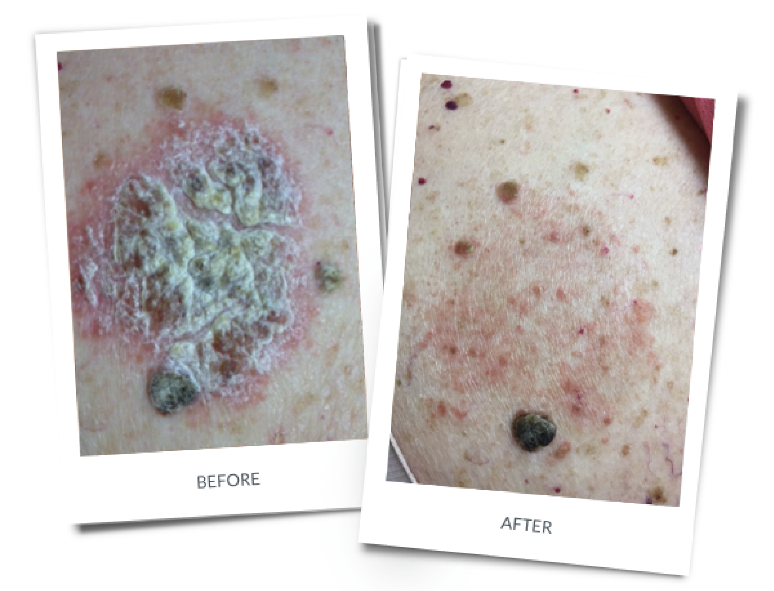Before and after: Psoriasis