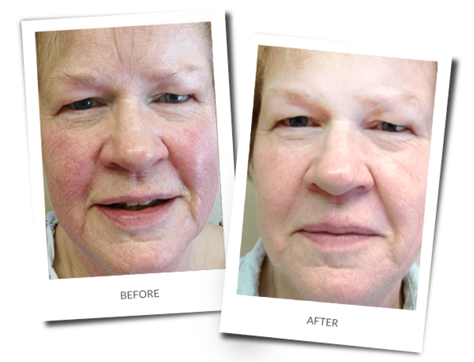 Before and after: Rosacea