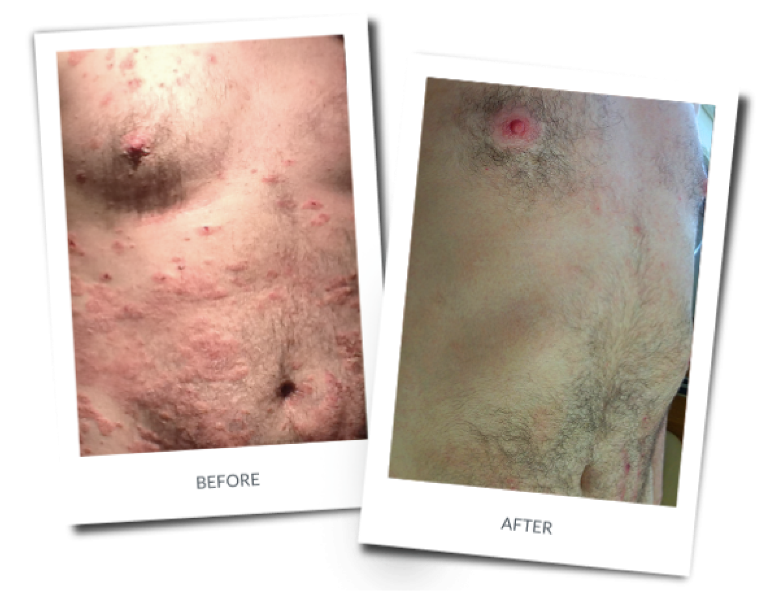 Before and after: Severe Atopic Dermatitis